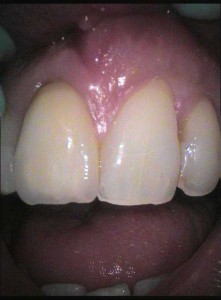 Fungo con neurodermatitis
