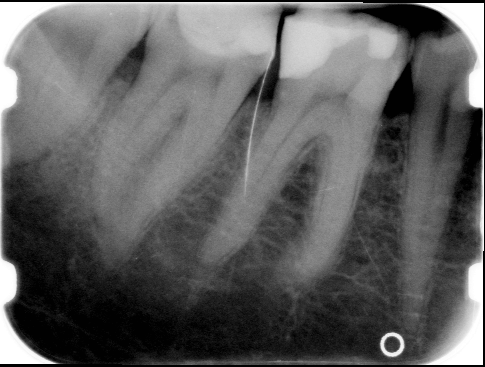 Pre endodontico