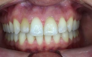 allineamento denti